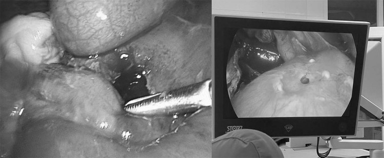 Phẫu thuật nội soi điều trị thủng tạng rỗng tại Bệnh viện Bãi Cháy. Ảnh BVCC