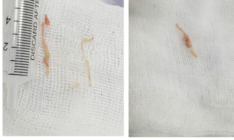 Nội soi khí phế quản gắp thành công dị vật là nhiều mảnh thức ăn bị hóc khỏi cơ thể trẻ. Ảnh BVCC