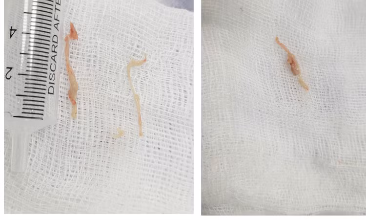 Nội soi khí phế quản gắp thành công dị vật là nhiều mảnh thức ăn bị hóc khỏi cơ thể trẻ. Ảnh BVCC