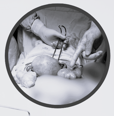 Khối u buồng trứng của sản phụ. Ảnh TTYT huyện Hiệp Hòa