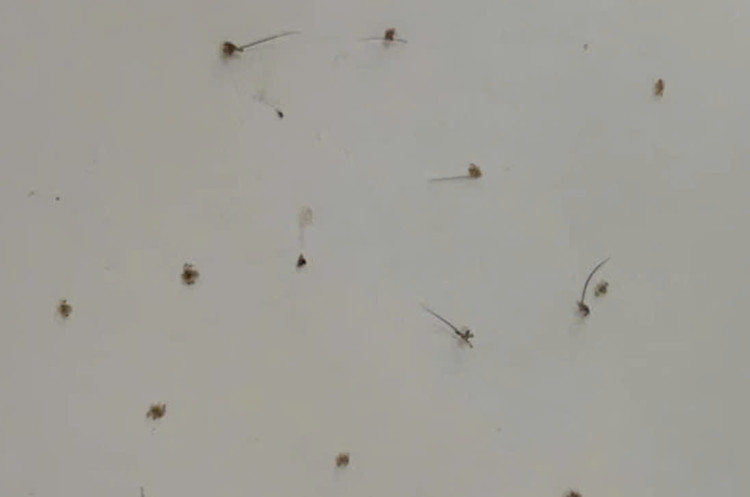 Rận bám chi chít trên mi mắt người phụ nữ 46 tuổi. Ảnh Vietnamnet