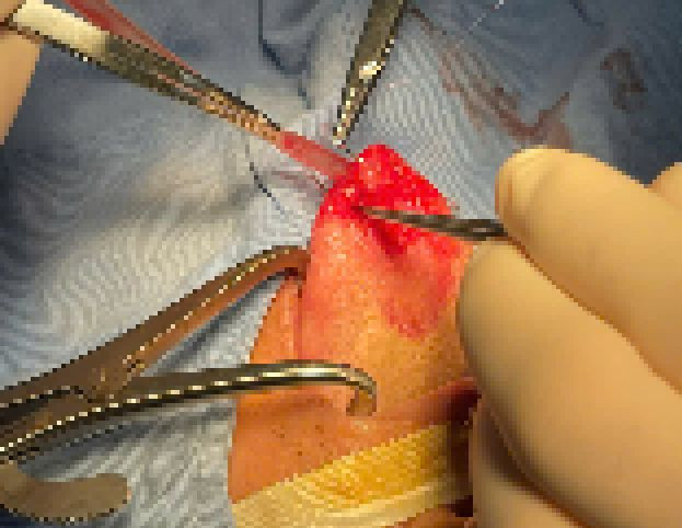 Các bác sĩ tiến hành loại bỏ khối u cho bệnh nhân. Ảnh TTYT huyện Đầm Hà