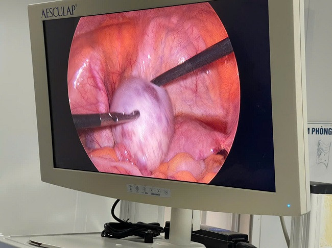 Hình ảnh khối U thực tế qua máy phẫu thuật nội soi. Ảnh TTYT huyện Đầm Hà