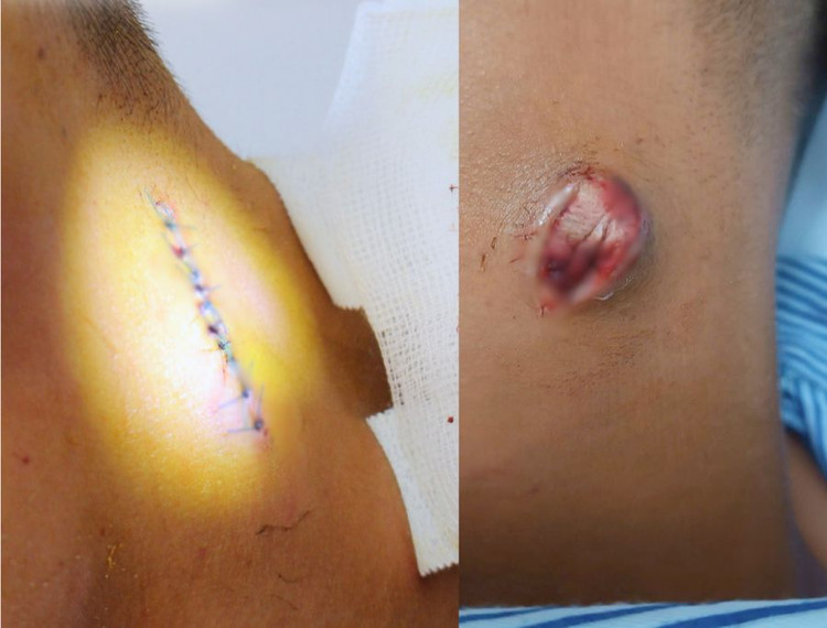 Nam thanh niên phải cấp cứu vì chủ quan với nốt mụn ở cổ. Ảnh BVCC