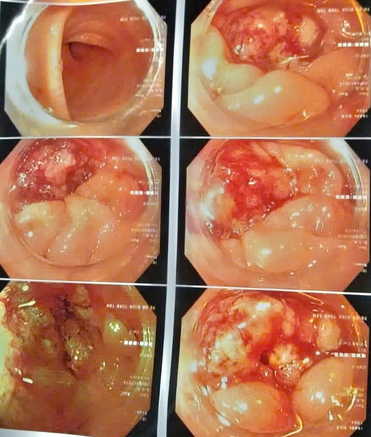 Hình ảnh tổn thương sùi loét đại tràng qua nội soi. Ảnh BVCC