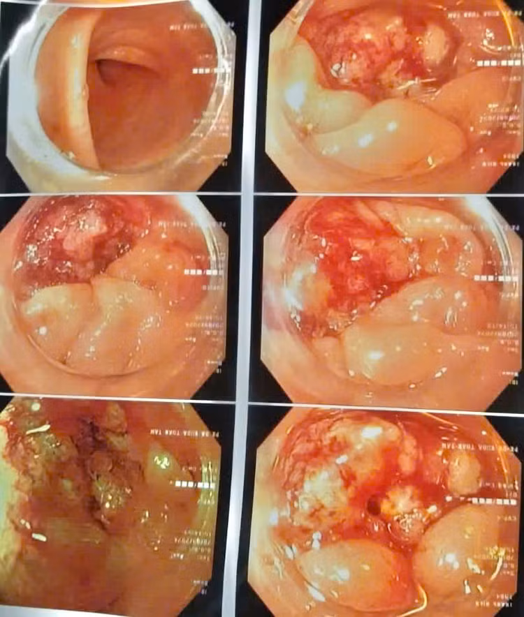 Hình ảnh tổn thương sùi loét đại tràng qua nội soi. Ảnh BVCC Hình ảnh tổn thương sùi loét đại tràng qua nội soi. Ảnh BVCC