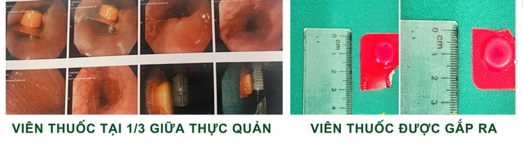 Hình ảnh viên thuốc còn nguyên vỏ vướng ngang thực quản bệnh nhân (bên trái) và viên thuốc được lấy ra (bên phải). Ảnh BVCC
