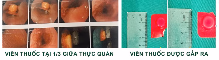 Hình ảnh viên thuốc còn nguyên vỏ vướng ngang thực quản bệnh nhân (bên trái) và viên thuốc được lấy ra (bên phải). Ảnh BVCC