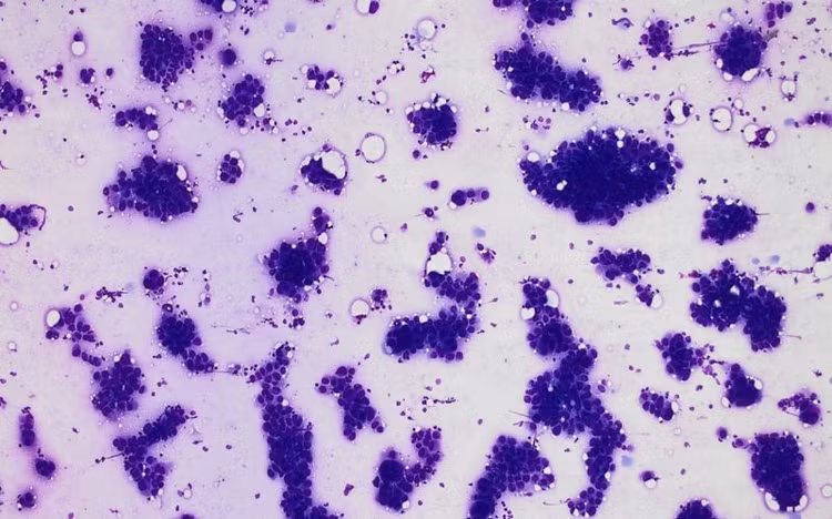 Bệnh nhân được chỉ định thực hiện kỹ thuật chọc hút kim nhỏ ở vú (FNA) cho kết quả hạch di căn ung thư biểu mô, nghĩ đến nguồn gốc tuyến vú> Ảnh BVCC