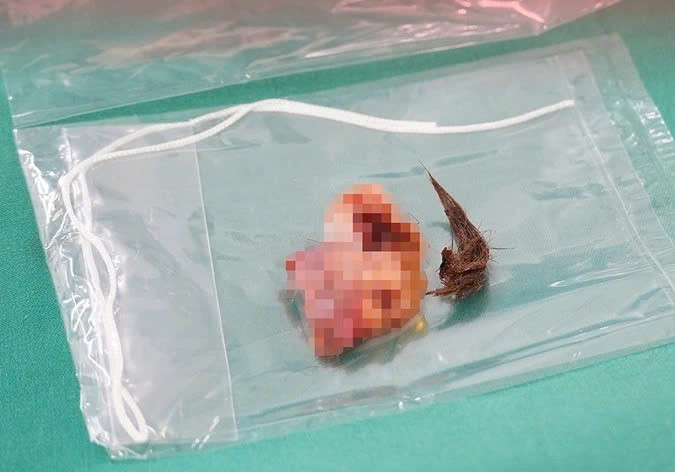 U quái buồng trứng chứa đầy lông của người phụ nữ. Ảnh: BVCC.