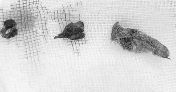 Dị vật là các mảnh bông gòn được gắp ra khỏi âm đạo bé gái. Ảnh BVCC