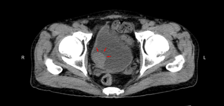Khối u phát triển đẩy vào lòng bàng quang kích thước 22*24mm. Ảnh BVCC Khối u phát triển đẩy vào lòng bàng quang kích thước 22*24mm. Ảnh BVCC