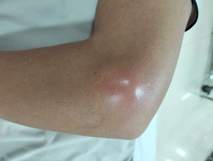 Người bệnh bị áp xe khuỷu tay. Ảnh BVCC