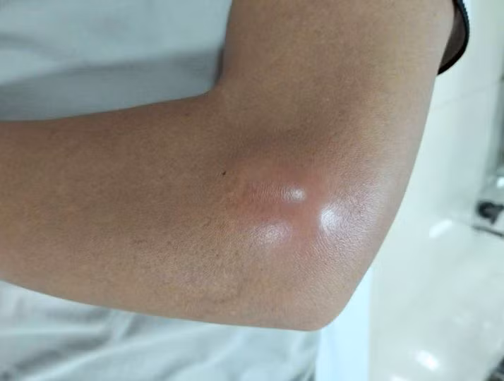 Người bệnh bị áp xe khuỷu tay. Ảnh BVCC Người bệnh bị áp xe khuỷu tay. Ảnh BVCC