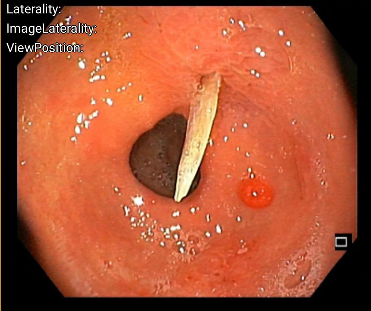 Hình ảnh dị vật qua nội soi. Ảnh BVCC