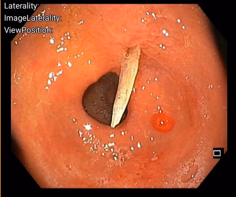 Hình ảnh dị vật qua nội soi. Ảnh BVCC