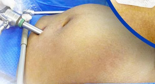 U nang buồng trứng khiến bụng người phụ nữ to như đang mang thai 4 tháng. Ảnh BVCC