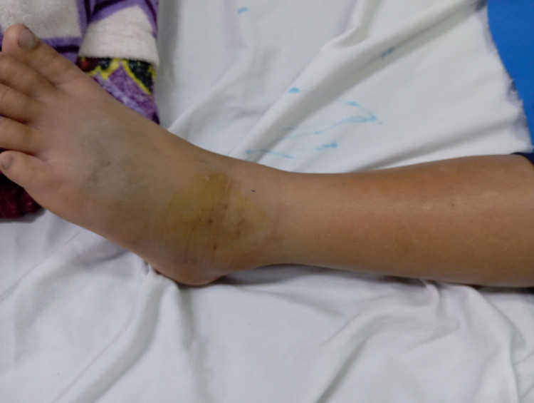 Trẻ bị rắn lục đuôi đỏ cắn vào chân. Ảnh BVCC