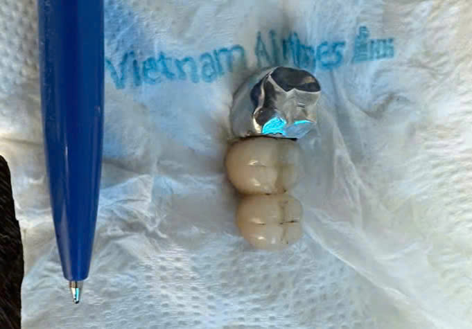 Dị vật sau khi đươc lấy ra. Ảnh BVCC