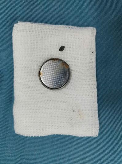 Cục pin đồng hồ hình tròn được nội soi gắp ra khỏi thực quản bé gái. Ảnh dongnai.gov