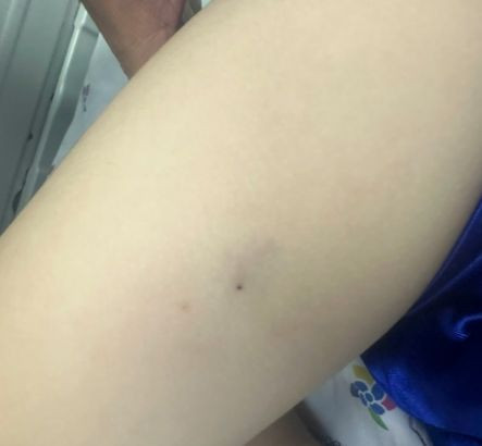 Vết ong ruồi đốt không gây hoại tử da như ong vò vẽ nhưng có thể gây ra sốc phản vệ. Ảnh BVCC