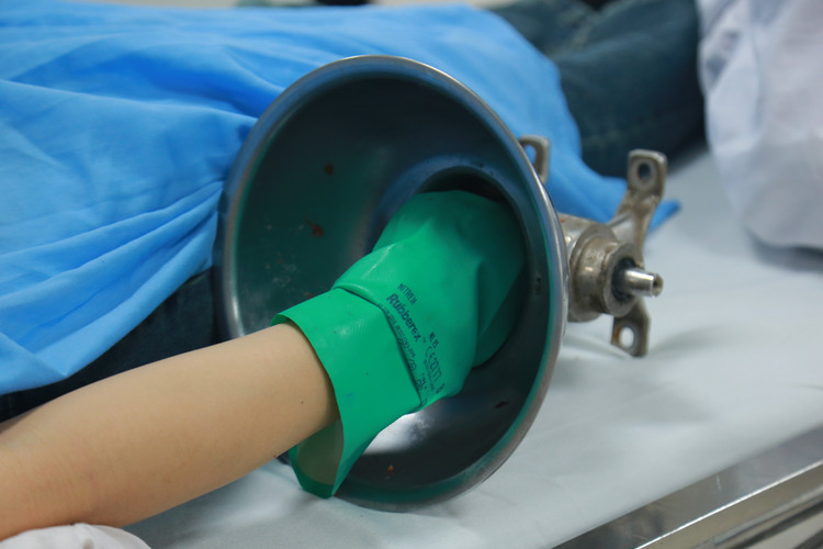 Bệnh nhân đến viện trong tình trạng bàn tay phải kẹt nguyên trong máy xay thịt. Ảnh BVCC