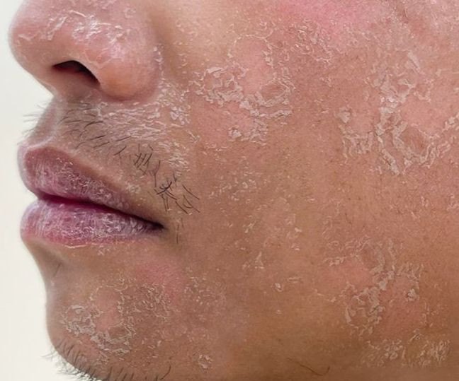 Bệnh nhân điều trị bỏng da tại bệnh viện. Ảnh BVCC