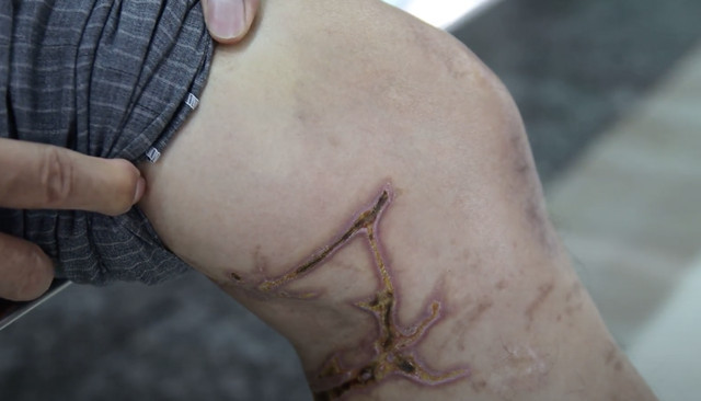 Một trường hợp bị sứa lửa đốt trong khi tắm biển.Ảnh: SK&amp;ĐS