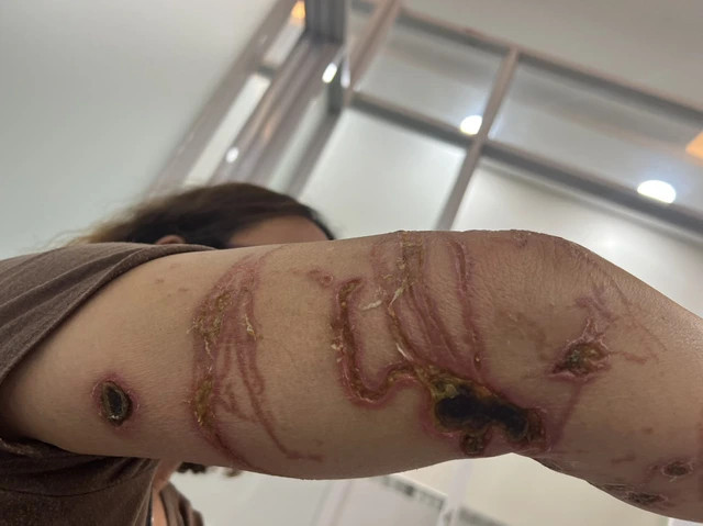 Da người phụ nữ lở loét, hoại tử sau khi tiếp xúc với sứa lửa. Ảnh SK&amp;ĐS