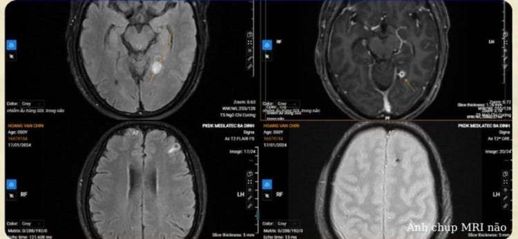 Nhiễm sán do thói quen thích ăn đồ sống. Ảnh BVCC