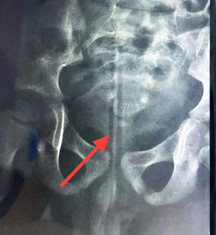 Hình ảnh chụp chiếu ghi nhận dị vật trong vùng kín bé trai. Ảnh BVCC