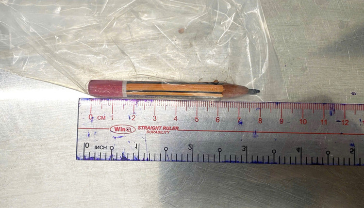 Dị vật là cây bút chì được lấy ra khỏi cơ thể bệnh nhi. Ảnh BVCC