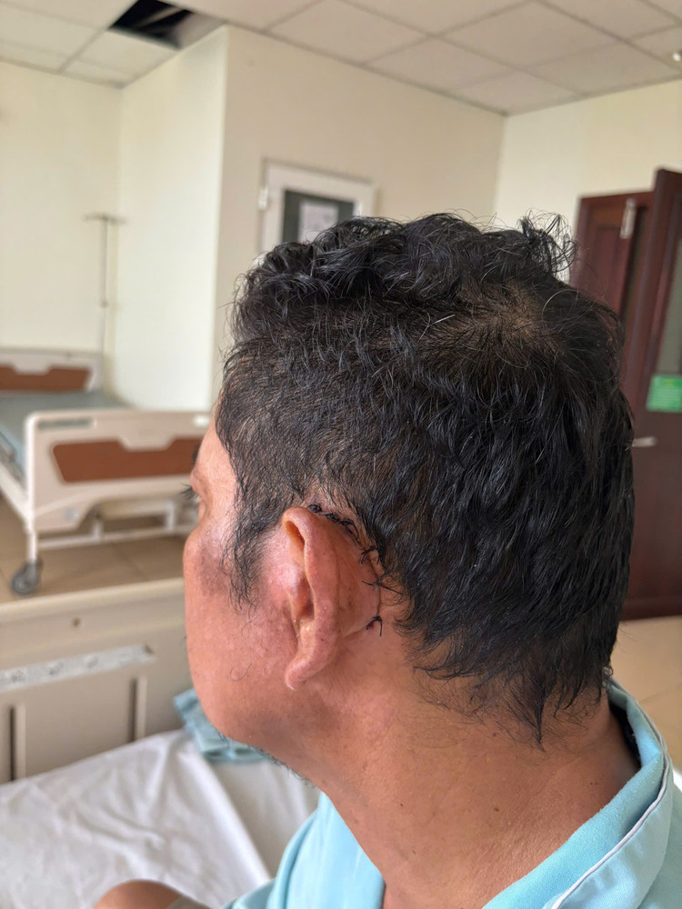 Bệnh nhân bị viêm tai xương chũm mãn tính biến chứng viêm màng não. Ảnh BVCC