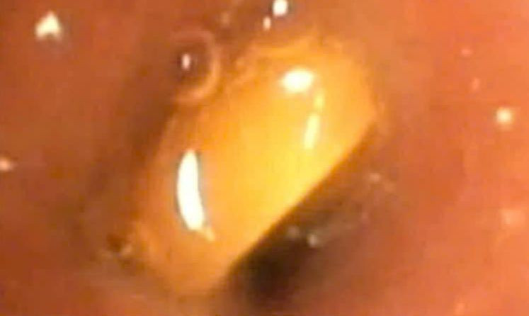 Dị vật gây bít tắc phế quản gốc phải. Ảnh BVCC