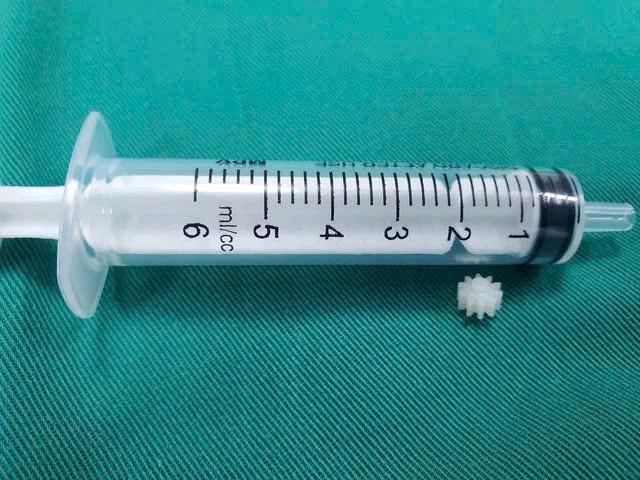 Dị vật mảnh lego bít tắc phế quản gốc trái của trẻ. Ảnh Sức khỏe và Đời sống