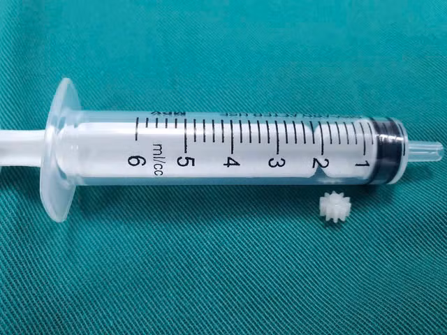 Dị vật mảnh lego bít tắc phế quản gốc trái của trẻ. Ảnh Sức khỏe và Đời sống