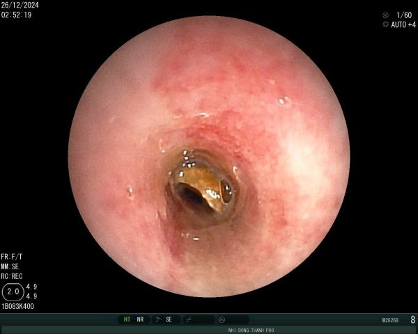 Hạt đậu phộng mắc kẹt ở khí quản gây tắc nghẽn đường thở. Ảnh BVCC