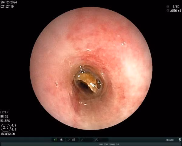 Hạt đậu phộng mắc kẹt ở khí quản gây tắc nghẽn đường thở. Ảnh BVCC