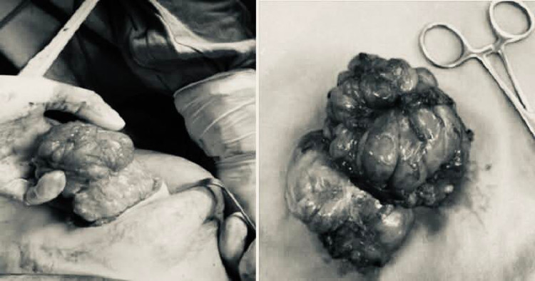 Hình ảnh khối u sau khi được phẫu thuật lấy ra. Ảnh BVCC