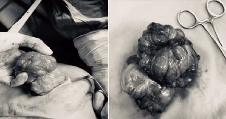 Hình ảnh khối u sau khi được phẫu thuật lấy ra. Ảnh BVCC