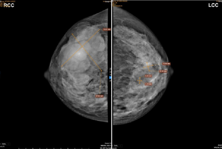 Kết quả chụp X-quang hai bên vú của bệnh nhân cho thấy có khối u lớn ở phần vú phải.