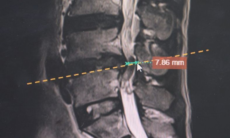 Ảnh chụp MRI thoát vị đĩa đệm của người bệnh. Ảnh BVCC