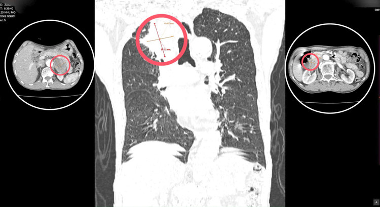 Phát hiện 3 khối u sau 30 năm không khám sức khỏe. Ảnh TTYT huyện Thanh Ba