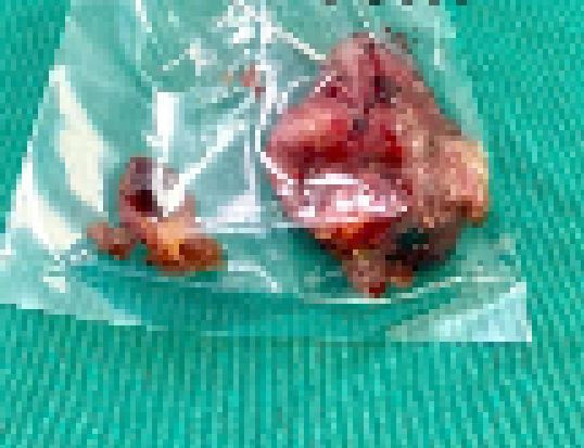 Khối U có kích thước 5x6cm. Ảnh TTYT huyện Yên Lập