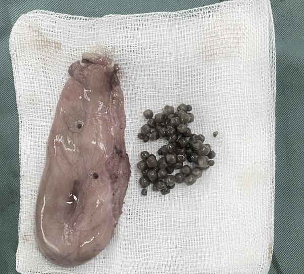 Hình ảnh sỏi trong túi mật được lấy ra từ bệnh nhân. Ảnh BVCC