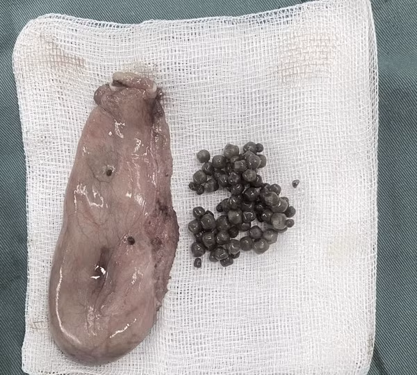 Hình ảnh sỏi trong túi mật được lấy ra từ bệnh nhân. Ảnh BVCC