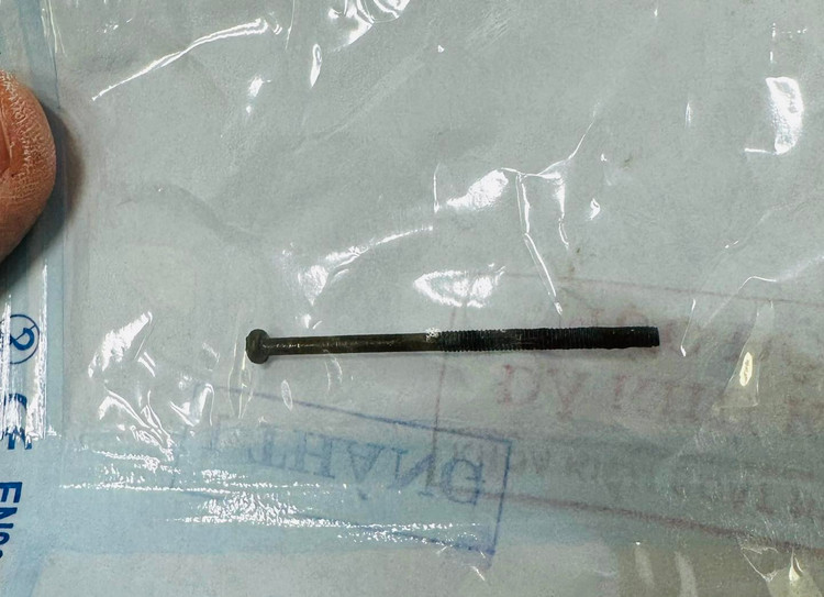 Chiếc đinh vít dài 4cm trong dạ dày bệnh nhi 3 tuổi. Ảnh BVCC