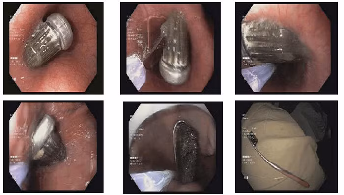 Hình ảnh bàn chải đánh răng trong bụng bệnh nhân. Ảnh BVCC