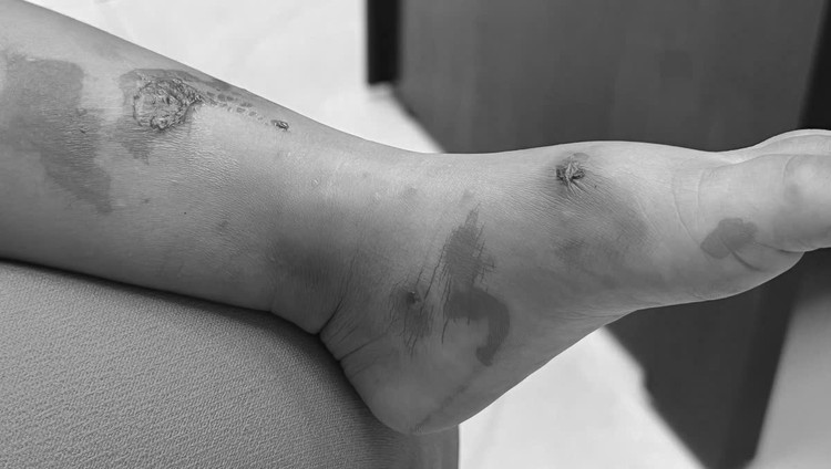 Bệnh chốc thường gặp ở trẻ nhỏ, đặc biệt là trẻ ở độ tuổi mẫu giáo. Ảnh: SK&amp;ĐS