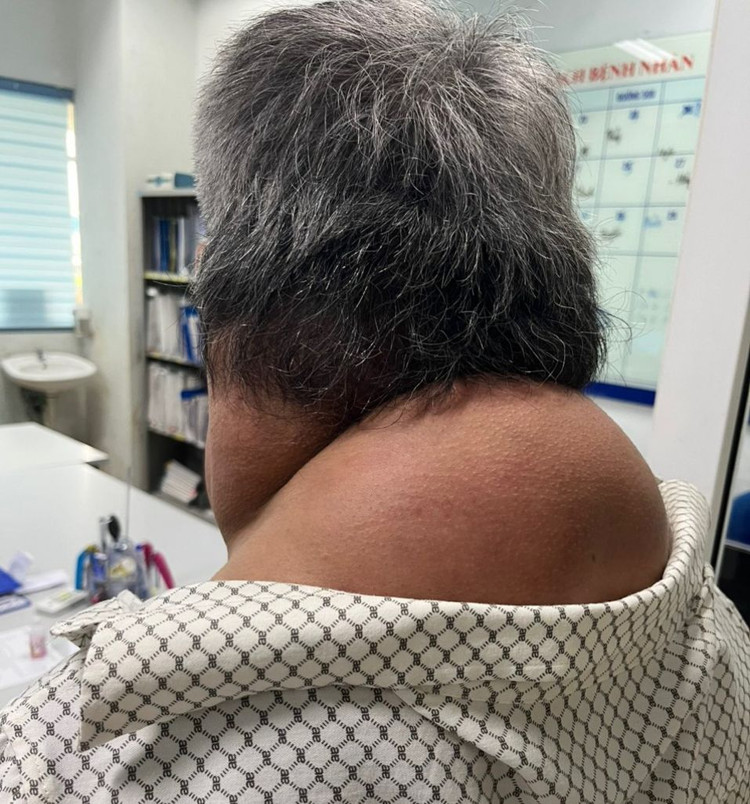 Khối mỡ ở vùng cổ và sau gáy của bệnh nhân trước khi được phẫu thuật loại bỏ. Ảnh: BVCC.